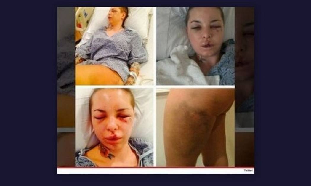 Σοκ: Ηθοποιός θύμα ξυλοδαρμού. Την σακάτεψε στο ξύλο ο πρώην της (Nassos blog)